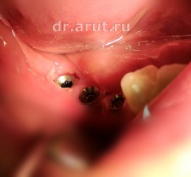 Имплантация в ортопедической стоматологии