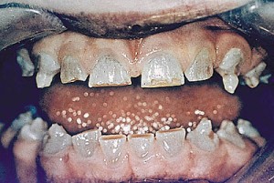 Болезнь Стейнтона-Капдепона