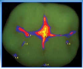 Диагностика кариеса