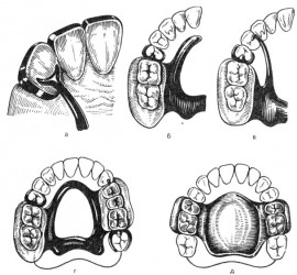 Фиксаторы непрямые