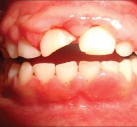 Гингивит у детей