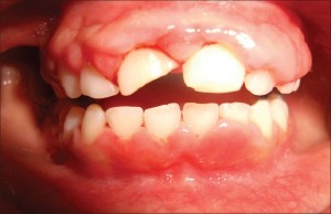 Гингивит у детей