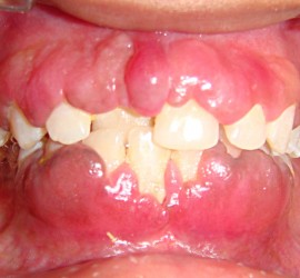 Гипертрофический гингивит