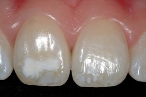 Очаговая гипоплазия