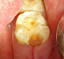 Глубокий кариес