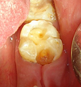 Глубокий кариес