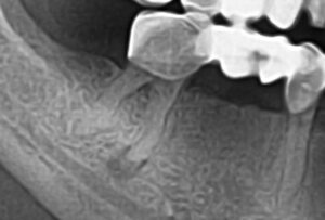 Хронический гранулематозный периодонит