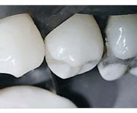 Hawe Diamond Strips
