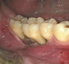 Идиопатические заболевания пародонта