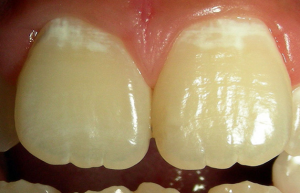 Начальный кариес, или кариес в стадии пятна