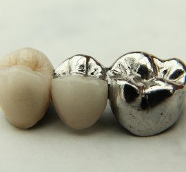 Мостовидные протезы комбинированные