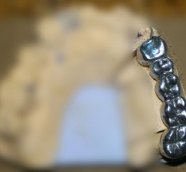 Мостовидные протезы цельнолитые