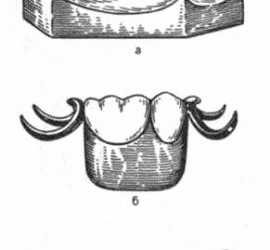 Малые седловидные протезы