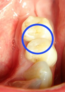 Поверхностный кариес