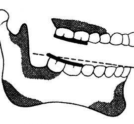 Окклюзионная сагиттальная кривая