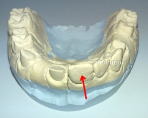 Отлом гипсового зуба