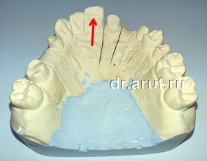 Отлом гипсового зуба