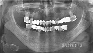 Мостовидные протезы прослужил 20 лет