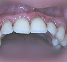 Генерализованный пародонтит