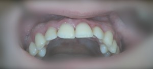 Генерализованный пародонтит