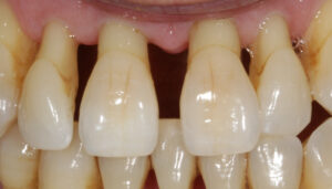 Пародонтоз