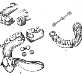 Протезы при ложных суставах