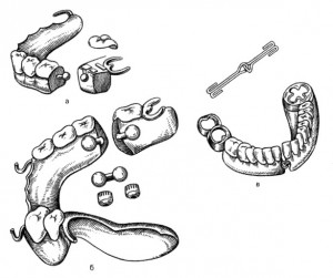 Протезы при ложных суставах