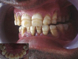 Системная неспецифическая гипоплазия тканей зуба