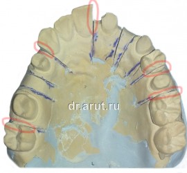 Спиленные боковые поверхности соседних зубов