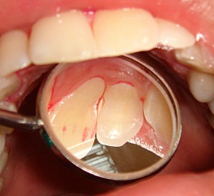 Средний кариес