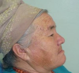 Прогения старческая