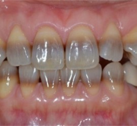 Тетрациклиновые зубы