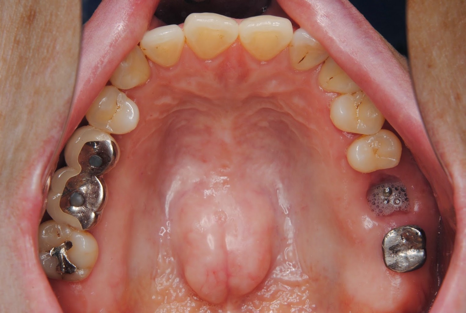 Торус небный — Стоматология