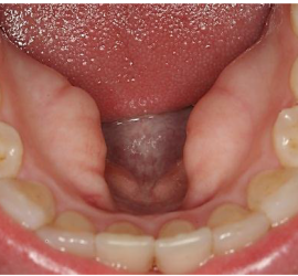 Торус подбородочно-подъязычный