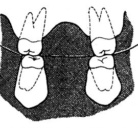 Окклюзионная (трансверсальная) кривая