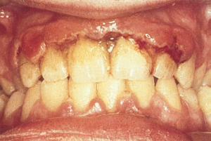 Язвенный гингивит