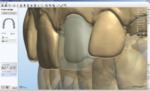 ЗD моделирование коронки