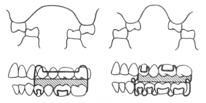 Аппарат для лечения перекрестного прикуса.