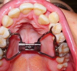 Дерихсвайлера аппарат