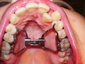 Дерихсвайлера аппарат