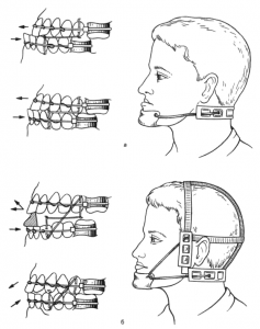 Дуги Энгля с межчелюстной (а) и внеротовой (б) тягой для лечения мезиального прикуса.