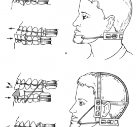 Дуги Энгля с межчелюстной (а) и внеротовой (б) тягой для лечения мезиального прикуса.