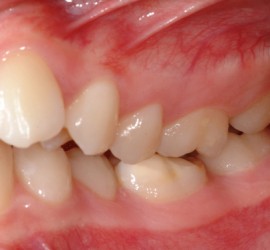 Эндопозиция зубов