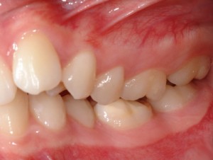 Эндопозиция зубов