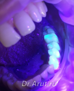 Флюоресцентная диагностика