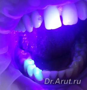 Флюоресцентная диагностика