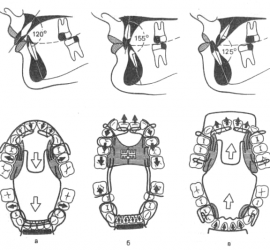 Формирователь прикуса Бимлера