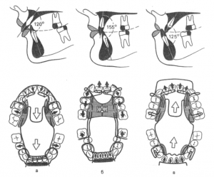 Формирователь прикуса Бимлера
