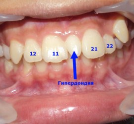 Гипердонтия