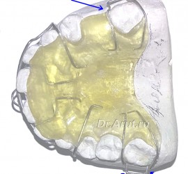 Кламмер Адамса